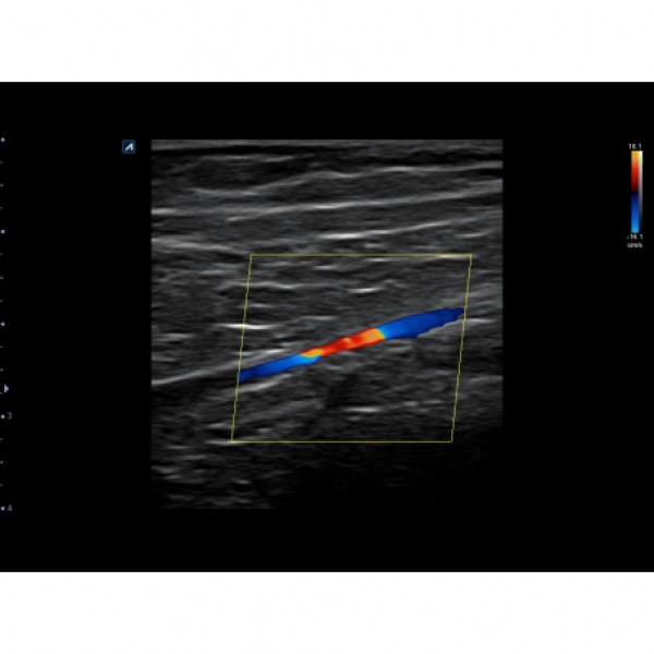 Φορητός υπέρηχος Alpinion MiniSono