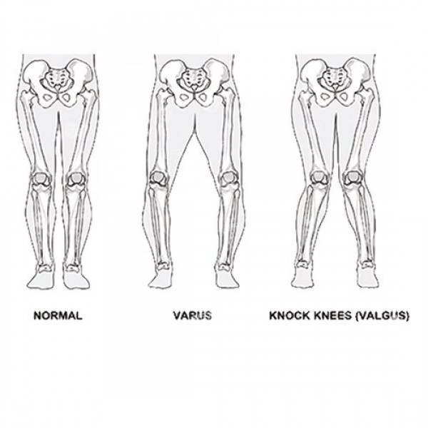 Νάρθηκας οστεοαρθρίτιδος γόνατος SPARTAN δεξί
